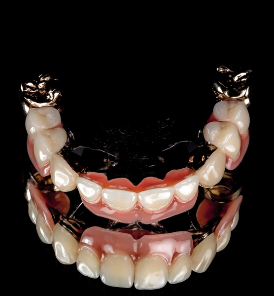 R&V Qualitätszahntechnik - Dentallabor - ein gegossenes Metallgerüst für eine herausnehmbare Teilprothese,